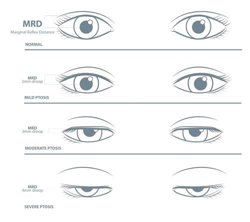 Ptosis deals